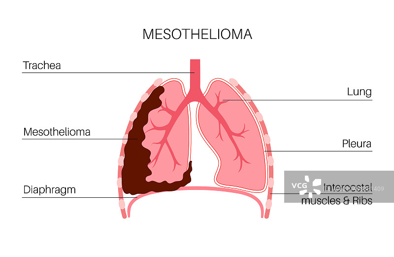 间皮瘤癌症疾病插图图片素材