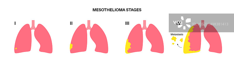 间皮瘤癌分期图图片素材