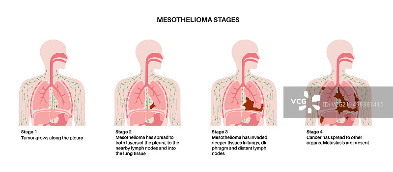 间皮瘤癌分期图图片素材