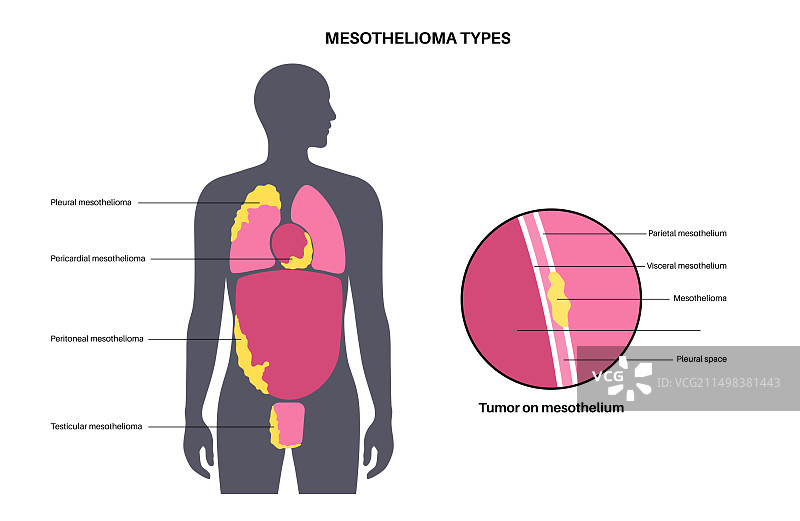 间皮瘤肿瘤类型图示图片素材