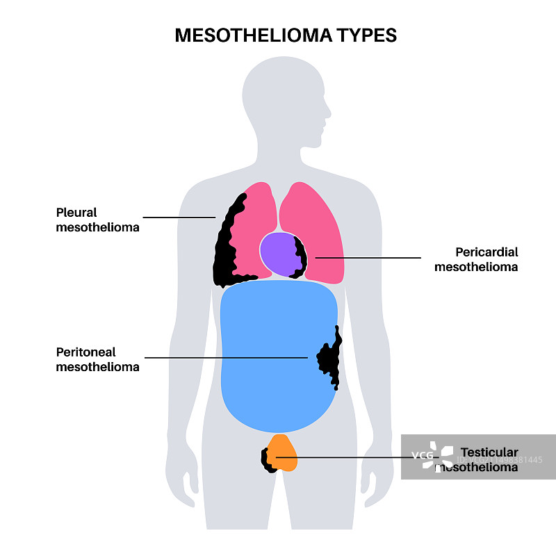 间皮瘤肿瘤类型图示图片素材