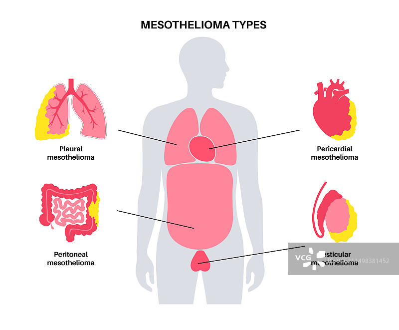 间皮瘤肿瘤类型图示图片素材