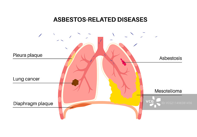 石棉相关疾病插图图片素材