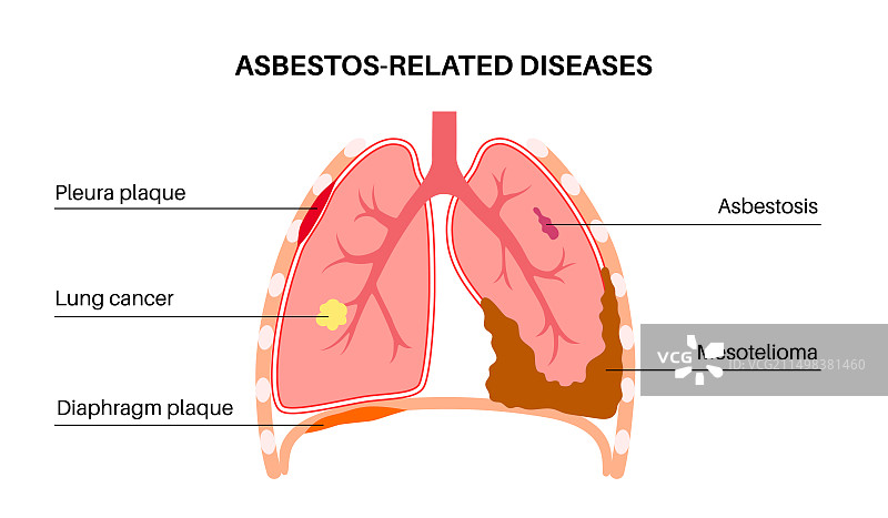 石棉相关疾病插图图片素材