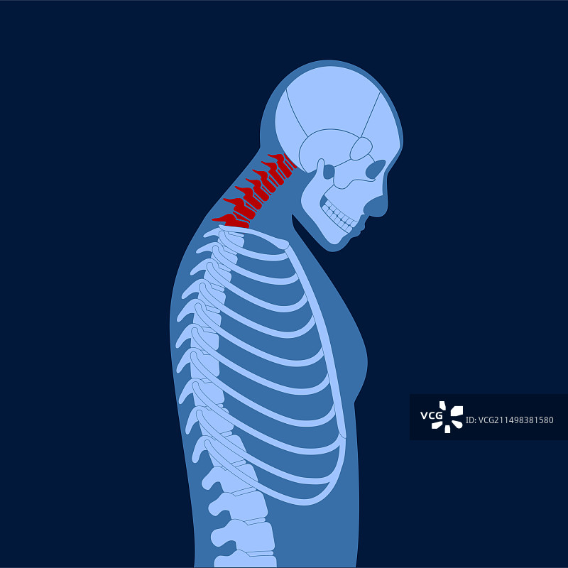 颈椎畸形插图图片素材