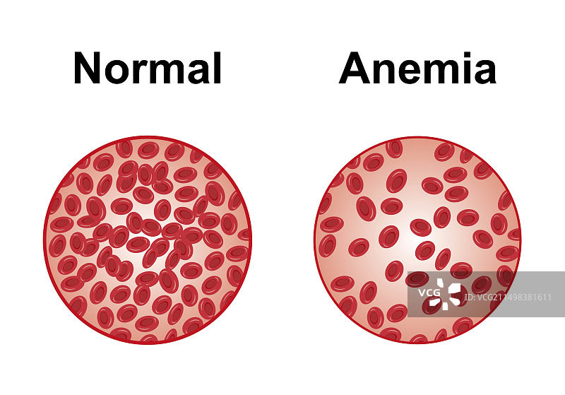正常和贫血血液图图片素材