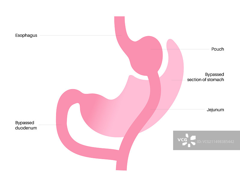胃旁路手术插图图片素材