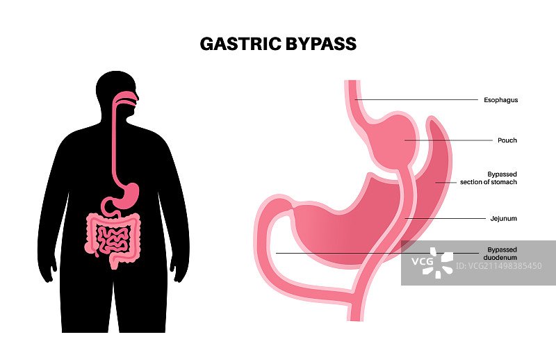 胃旁路手术插图图片素材