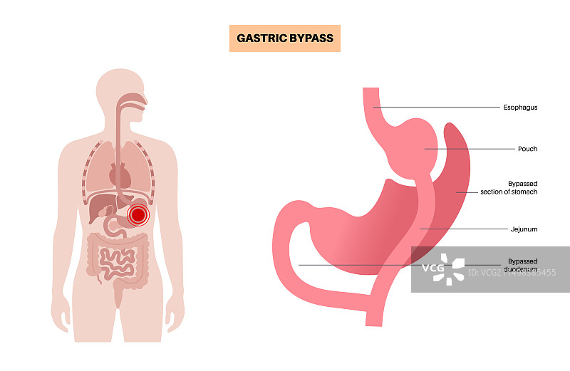 胃旁路手术插图图片素材