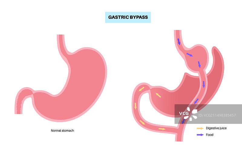 胃旁路手术插图图片素材