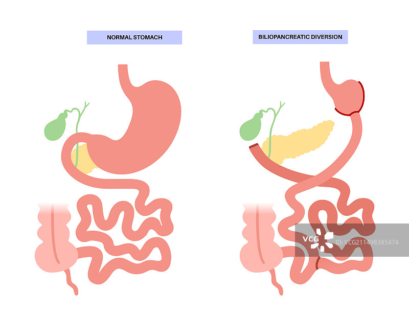 胆胰转流术图示图片素材