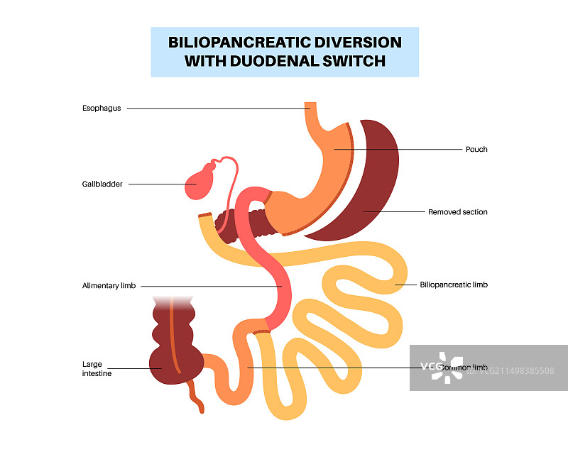 胆胰转流术图示图片素材