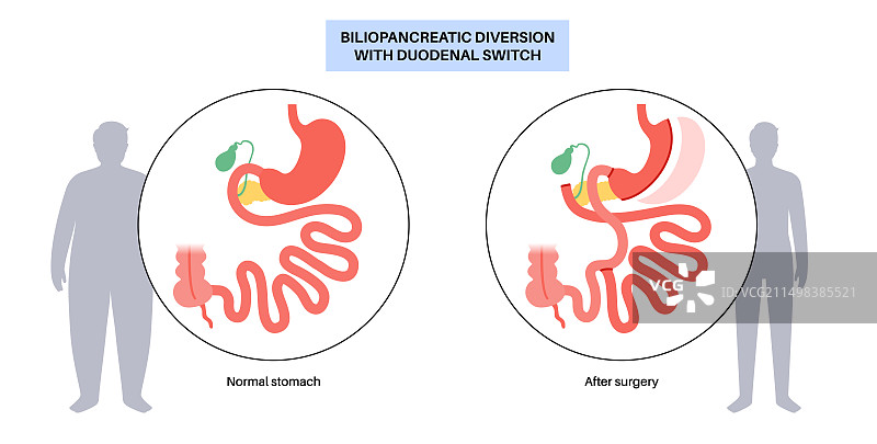 胆胰转流术图示图片素材
