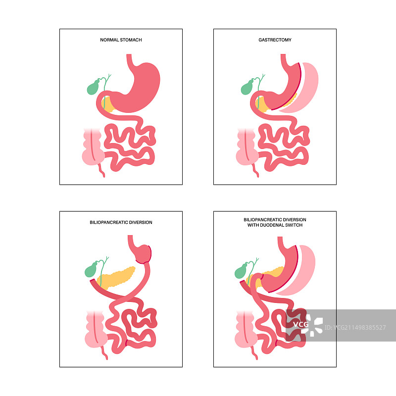 减肥外科手术类型图解图片素材