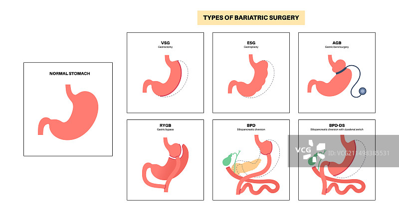 减肥外科手术类型图解图片素材