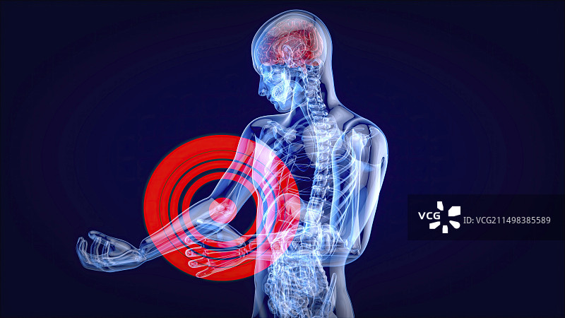 肘部疼痛概念图图片素材