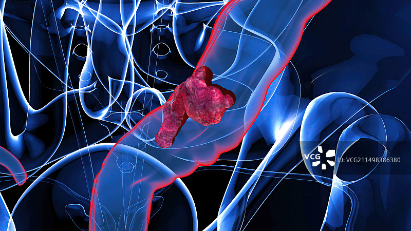 结肠癌概念图图片素材