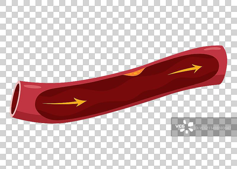 动脉粥样硬化心脏病发作解剖图图片素材