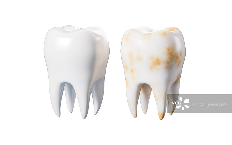 牙齿牙菌斑牙结石牙垢3D渲染图片素材