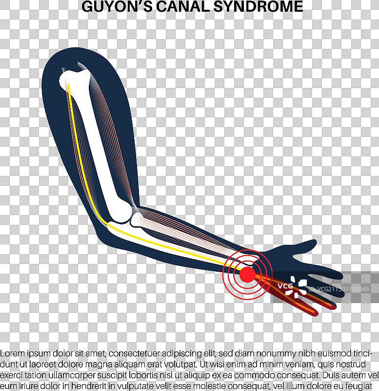尺管综合征图片素材