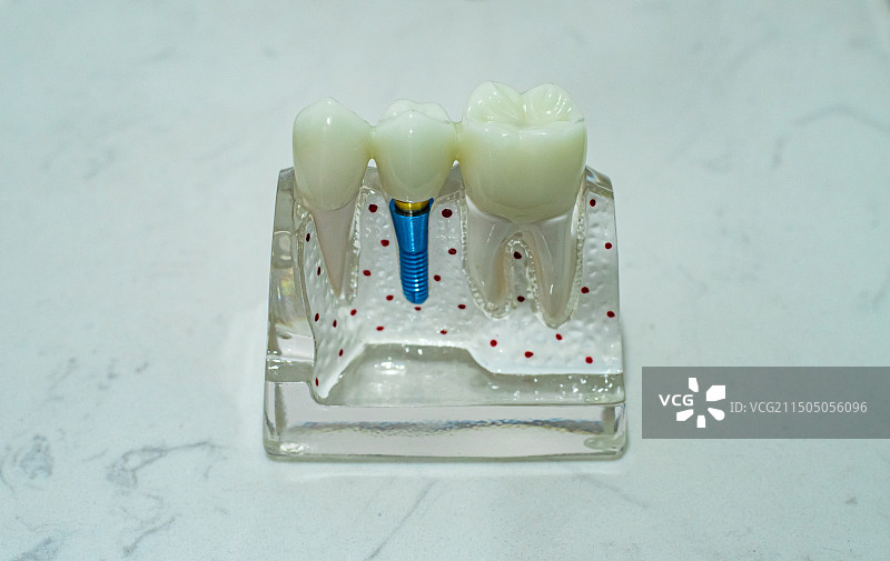中国医学医疗用品标本拍摄主题，人体牙齿种植牙齿的模型，室内无人图像摄影图片素材