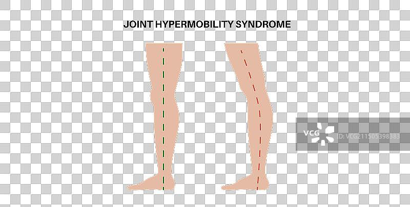 关节过度活动海报图片素材
