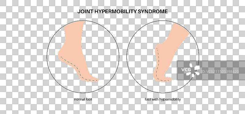 关节过度活动海报图片素材