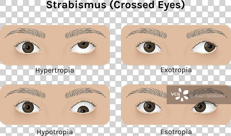 患有斜视的逼真人眼图片素材