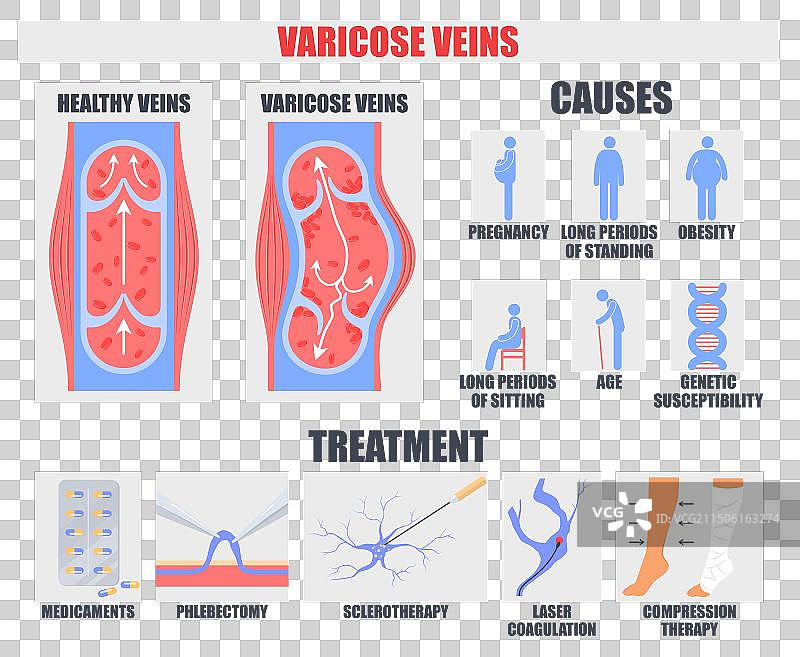 静脉曲张病因与治疗医学海报图片素材