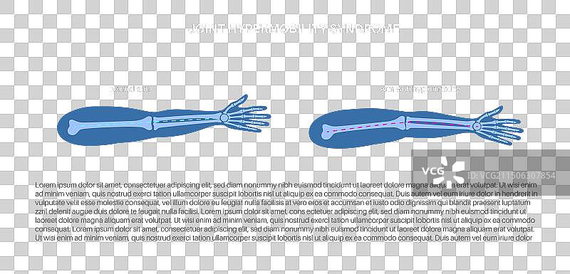 关节过度活动海报图片素材