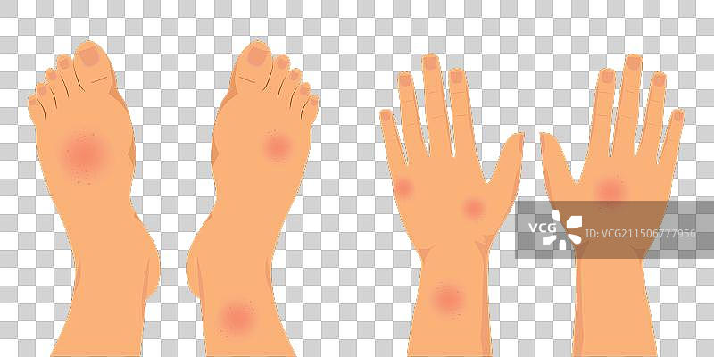 覆盖着红色皮疹的人腿和手图片素材