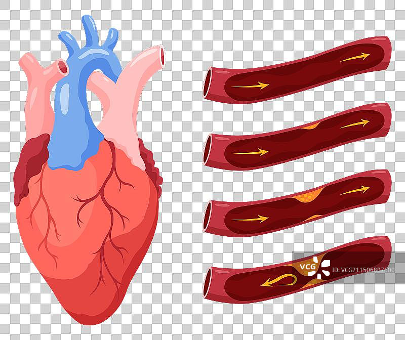 心脏病发作动脉粥样硬化阶段解剖图片素材