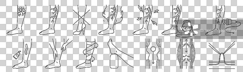 静脉曲张疾病症状治疗医学图片素材