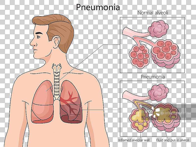 人肺部肺炎图医学图片素材