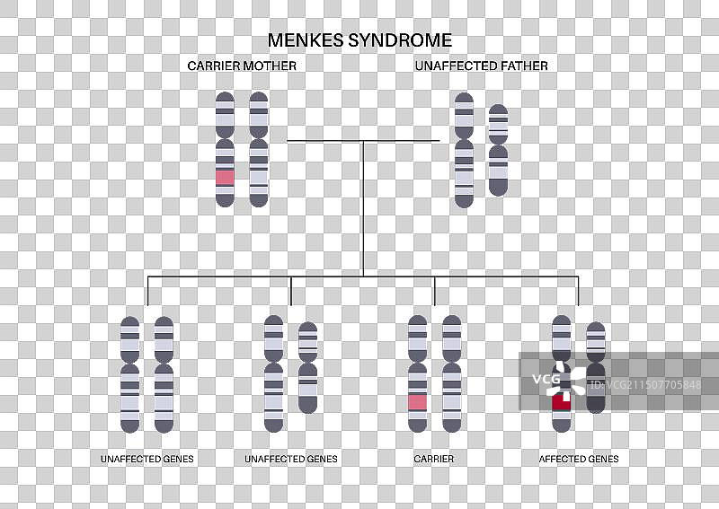 Menkes综合征海报图片素材