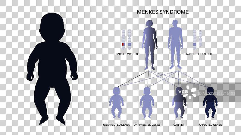 Menkes综合征海报图片素材