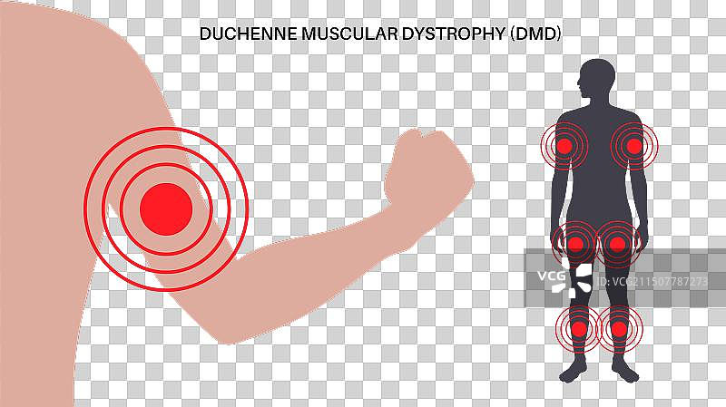 杜氏肌营养不良图片素材