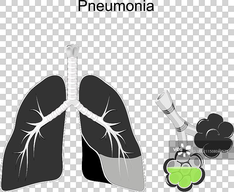 肺炎人体肺部横截面图片素材