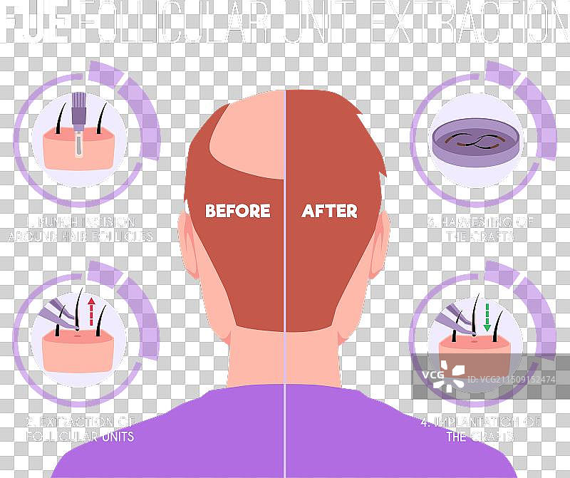 男士植发医疗信息图图片素材