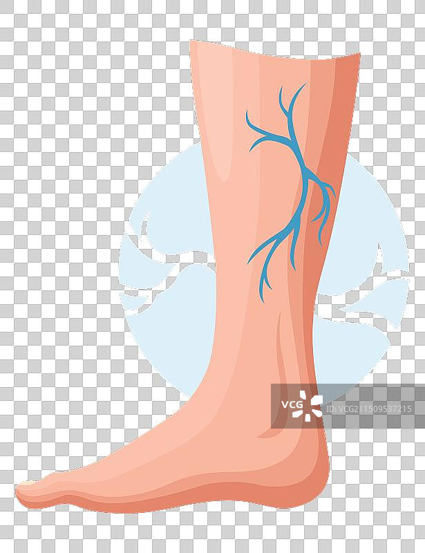 静脉曲张的发展阶段或类型图片素材