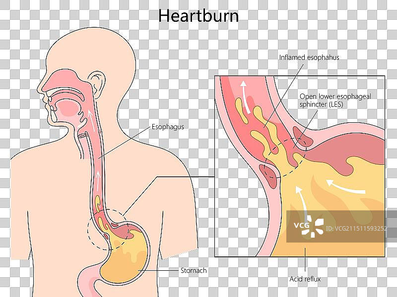胃灼热和胃酸倒流图医疗图片素材