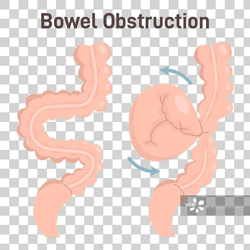 肠梗阻或肠扭转图片素材