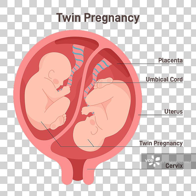 双胞胎妊娠子宫解剖图图片素材