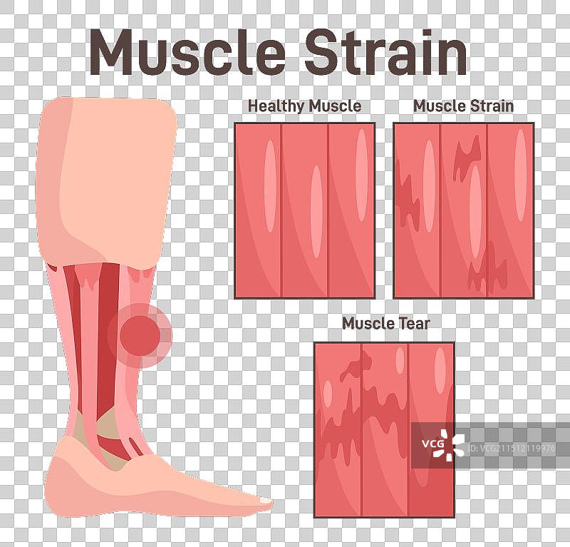 腿部肌肉损伤和肌肉拉伤图片素材