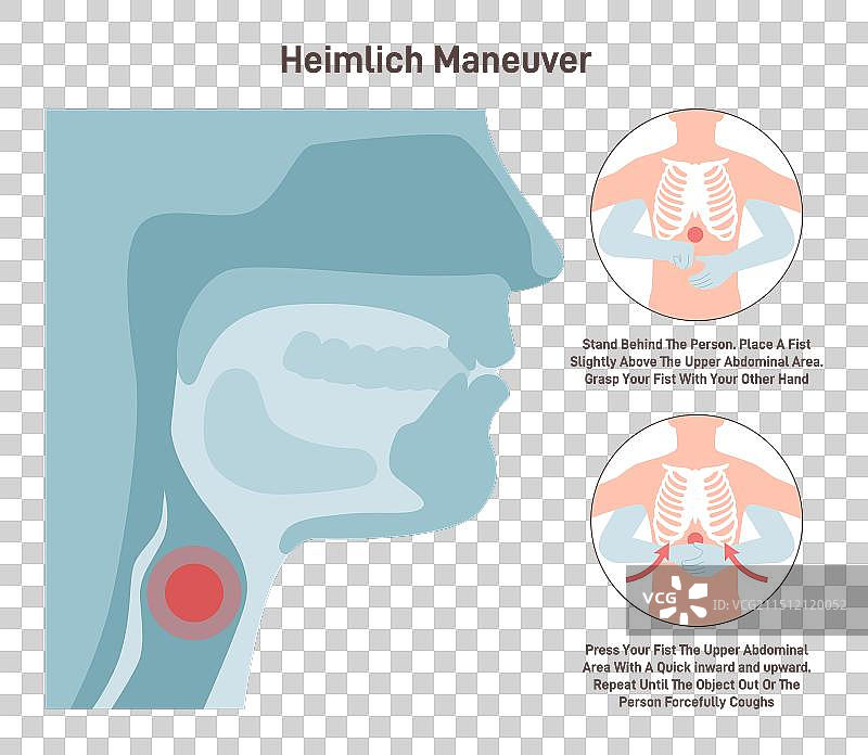 海姆立克急救法图片素材