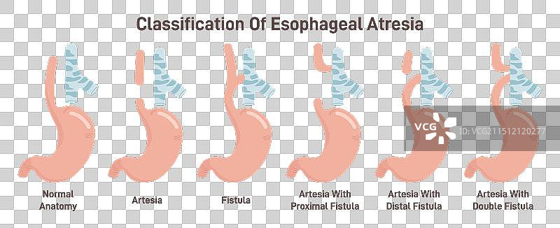 先天性食管闭锁类型医学图图片素材
