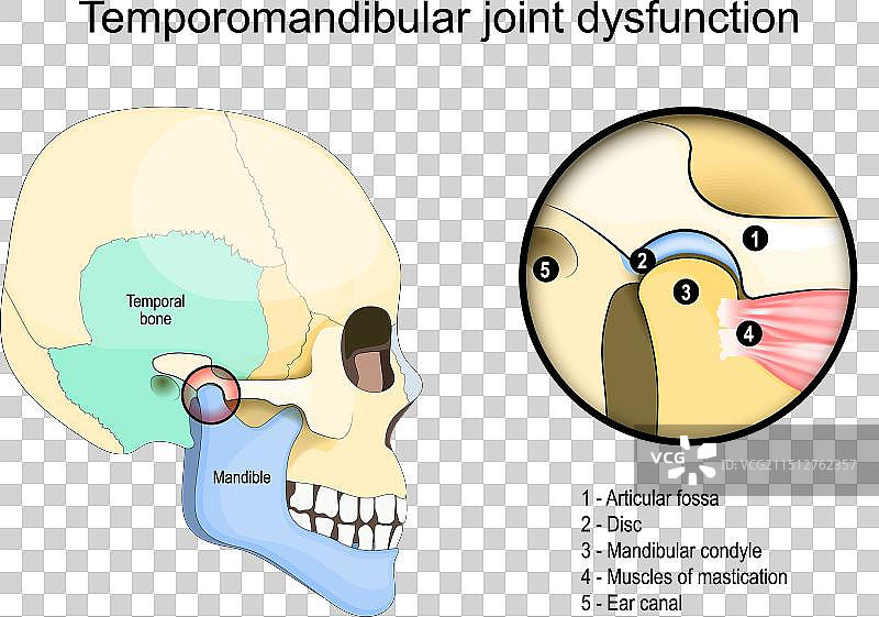 颞下颌关节功能障碍综合征侧面图图片素材