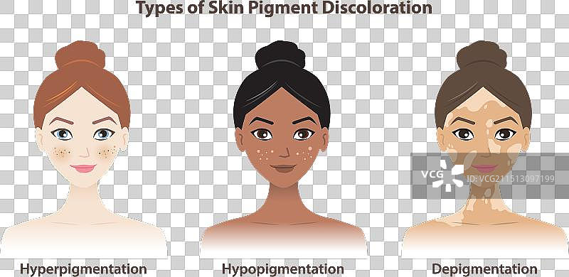 皮肤色素变色的类型图片素材