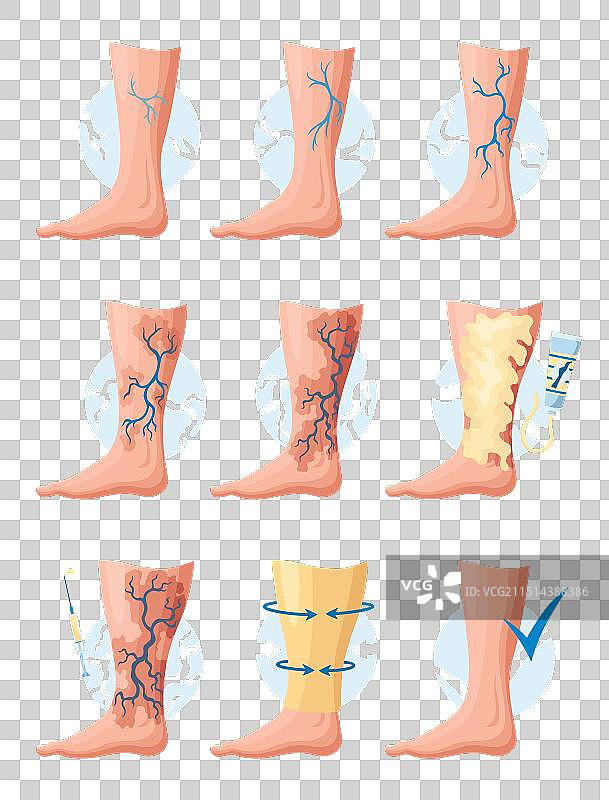 静脉曲张的发展阶段或类型图片素材