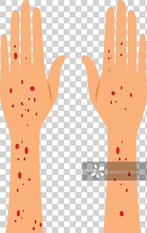 手部皮疹症状卡通图片素材